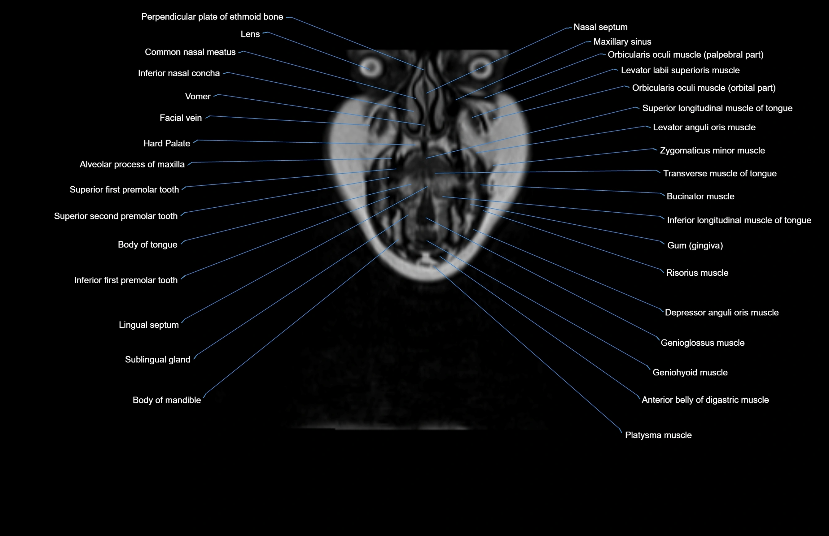 Neck coronal cross sectional MRI anatomy 3T MRI  image-img-00001-00070.webp